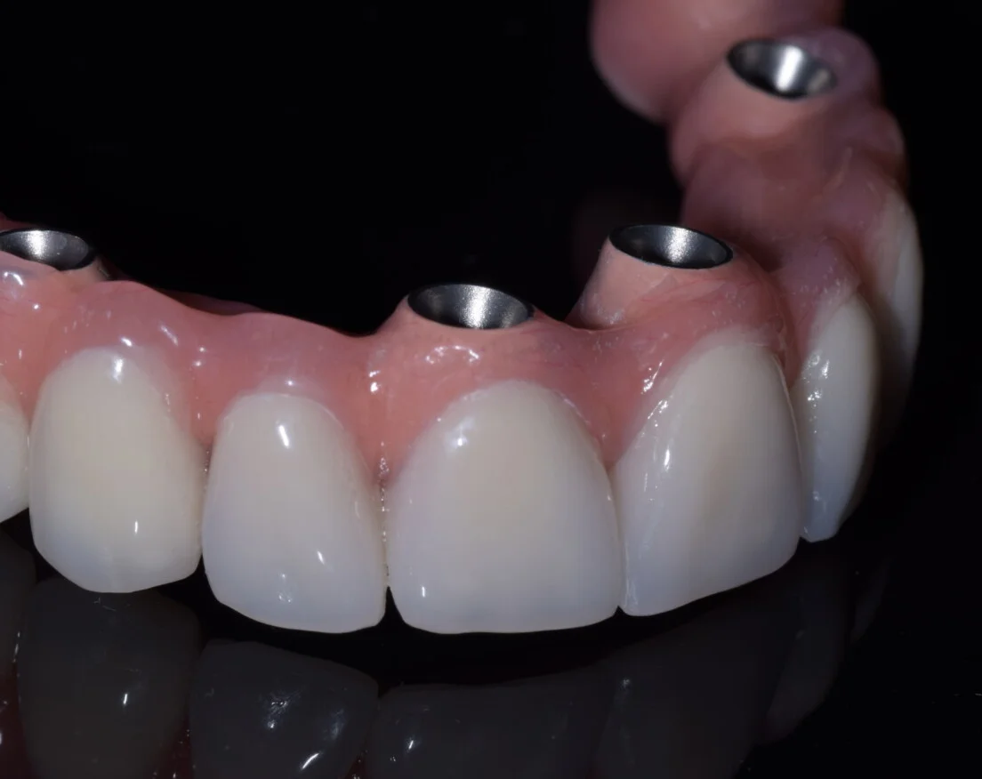 CABINET DENTAIRE PULLY - Réhabilitation total d'une ou deux mâchoires