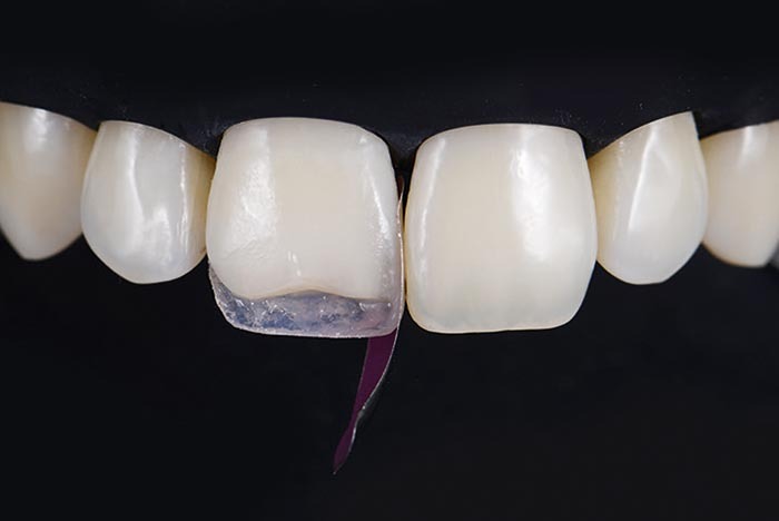 Pully Dentaire - Facettes en Composite