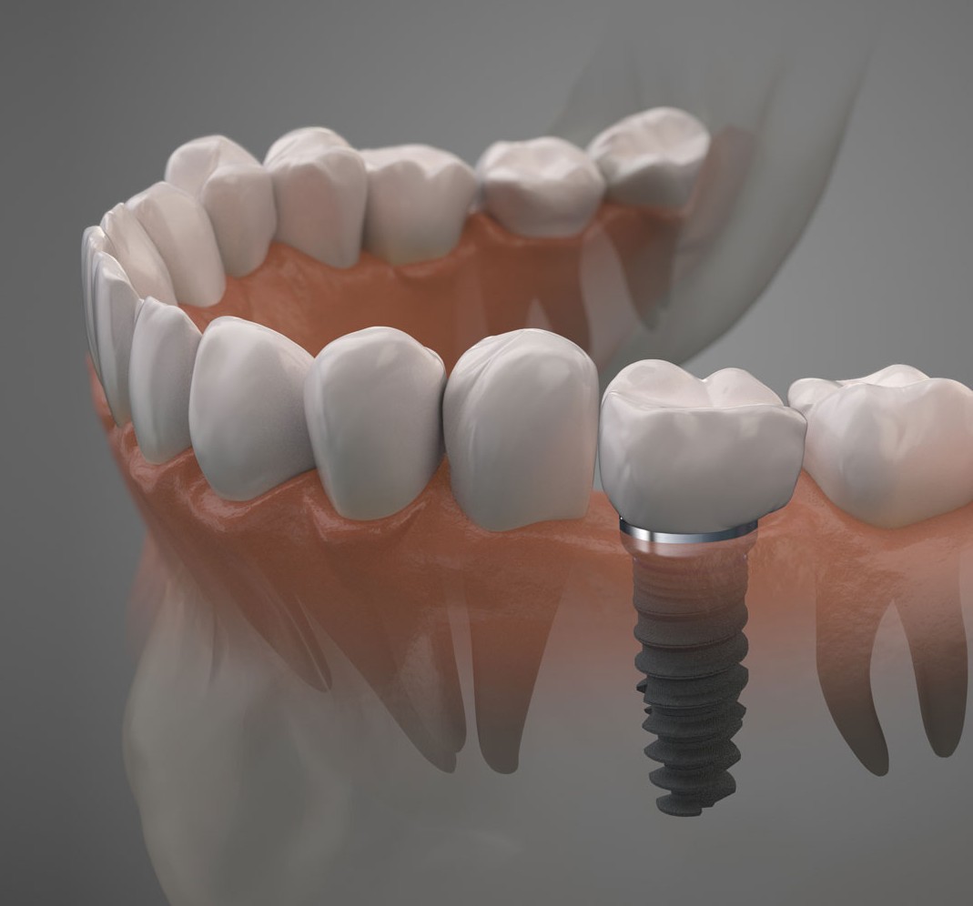 Pully Dentaire - Implants dentaires ou couronnes Pully Dentaire - Implants dentaires ou couronnes